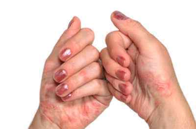 Як виглядає псоріаз рук на фото? Симптоми і причини виникнення захворювання шкіри рук