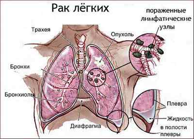 Як виглядає рак легенів на рентгені