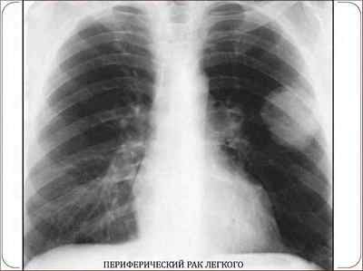 Як виглядає рак легенів на рентгені