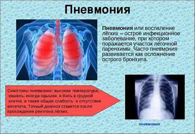 Як виглядає рентгенівський знімок легенів здорової людини
