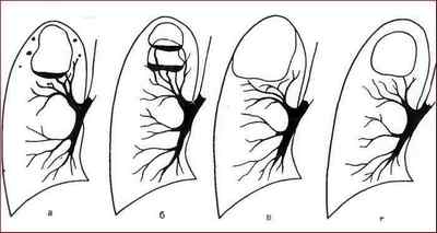 Як виглядає туберкульоз на рентгені і флюорографії