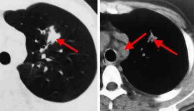 Як виглядає туберкульоз на рентгені і флюорографії