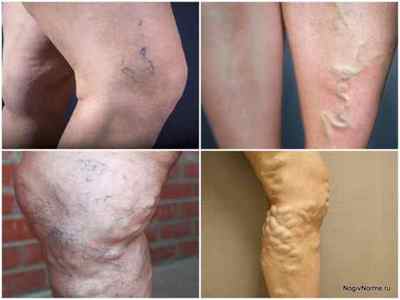 Як виглядає варикоз на ногах: фото, види, стадії хвороби