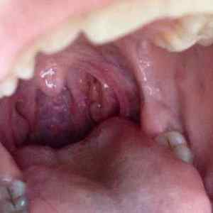 Як виглядають папіломи в роті у людини? Від чого зявляються нарости і як їх видалити?