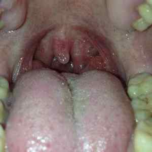 Як виглядають папіломи в роті у людини? Від чого зявляються нарости і як їх видалити?