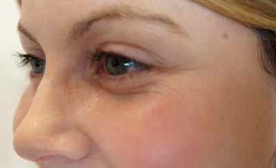 Як використовувати масло обліпихи від зморшок на обличчі і шкірі навколо очей: найефективніші способи