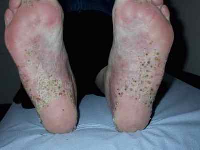Як вилікувати псоріаз ніг назавжди в домашніх умовах? Симптоми хвороби і фото псоріазу ніг
