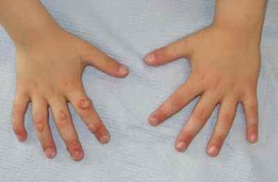 Як вивести бородавку на пальці ноги: лікування у дитини в домашніх і поліклінічних умовах