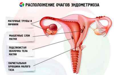 Як виявити ендометріоз: характерні риси патології