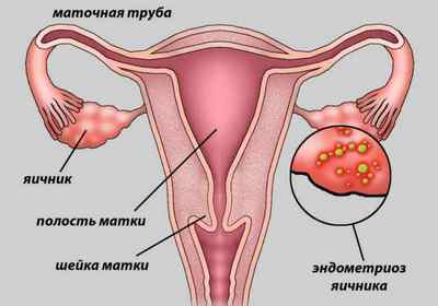 Як виявити ендометріоз матки?
