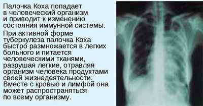 Як виявити туберкульоз легенів на ранній стадії