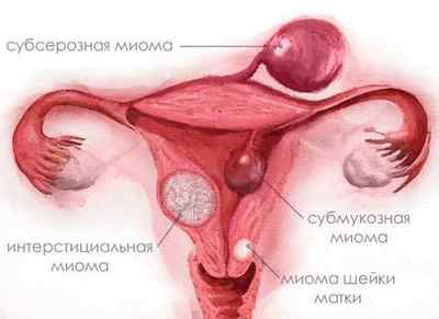 Як визначити і призначити лікування при міомі шийки матки