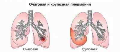 Як визначити запалення легенів - діагностика пневмонії у дорослих