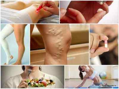 Як запобігти варикозу на ногах - поради з профілактики та зупинки розвитку хвороби