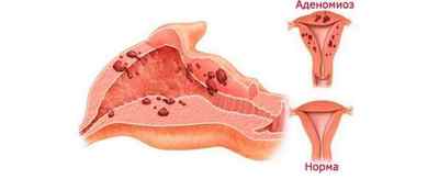 Як завагітніти при аденомиозе