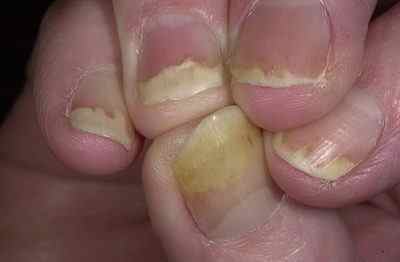 Як здійснюється лікування псоріазу нігтів на руках в домашніх умовах за допомогою таких засобів, як мазі і таблетки?