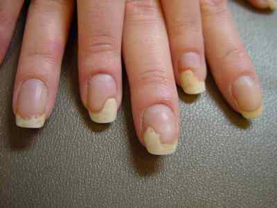 Як здійснюється лікування псоріазу нігтів на руках в домашніх умовах за допомогою таких засобів, як мазі і таблетки?