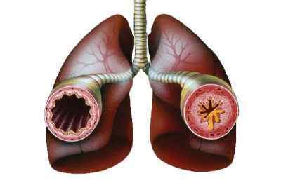 Як зняти напад астми в домашніх умовах