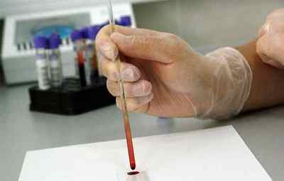 Яка повинна бути норма АЛТ і АСТ в аналізі крові здорової людини