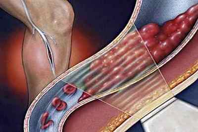 Який аналіз крові потрібно здати для визначення тромбів