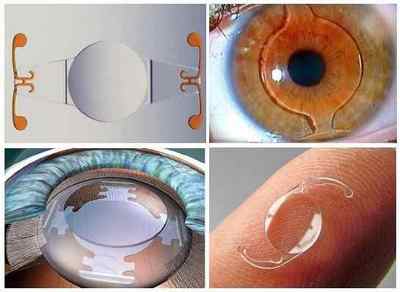 Який кришталик краще для операції при катаракті: відгуки, які бувають
