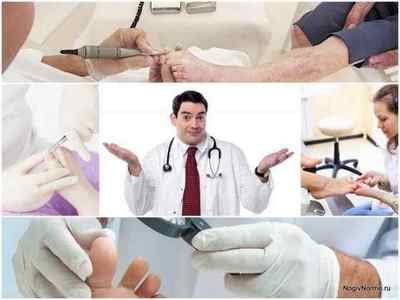 Який лікар лікує грибок нігтів на ногах, до кого звернутися