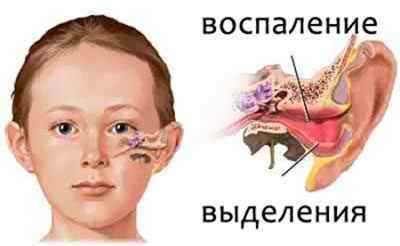 Йде кров з вуха у дитини: причини і лікування