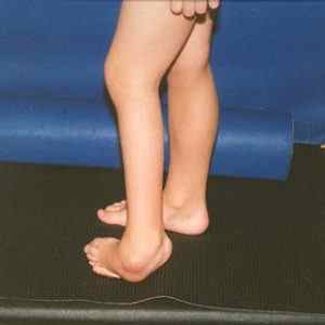 Ювенільний ревматоїдний артрит: симптоми і лікування у дітей, причини, ідіопатичний і пауціартікулярний артрит, діагностика | Ревматолог