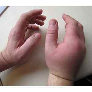 Забій лучезапястного суглоба: лікування травми на руці, межзапястние і среднезапястного суглоб болить | Ревматолог