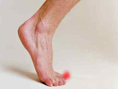 Забій пальця на нозі - симптоми, лікування і ускладнення