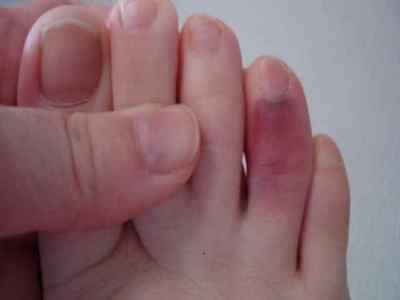 Забій пальця на нозі - симптоми, лікування і ускладнення