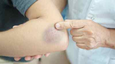 Забій руки: що робити при сильному ударі при падінні або ударі, опухла рука, як лікувати в домашніх умовах, симптоми травми | Ревматолог
