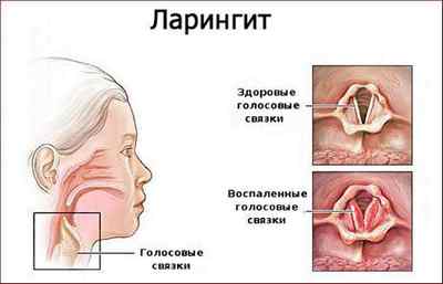 Захворювання горла і гортані: ознаки, симптоми і лікування