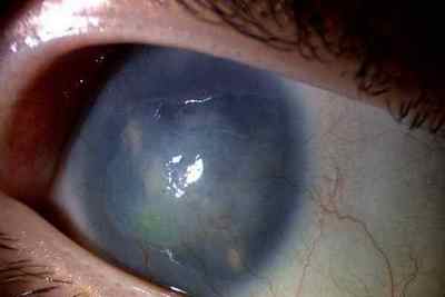 Захворювання очей у хворих на цукровий діабет: опису і особливості