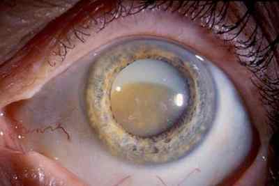 Захворювання очей у хворих на цукровий діабет: опису і особливості
