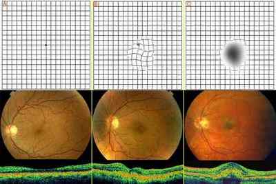Захворювання сітківки ока: лікування патологій і дефектів народними засобами, симптоми уражень