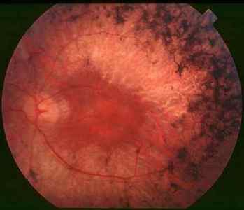 Захворювання сітківки ока: лікування патологій і дефектів народними засобами, симптоми уражень