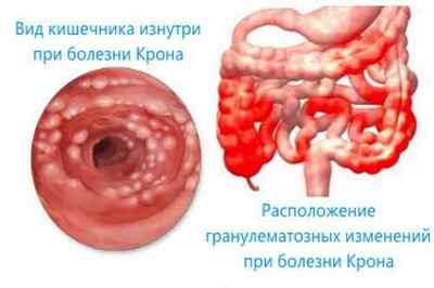 Захворювання тонкого кишечника: симптоми і лікування патологій