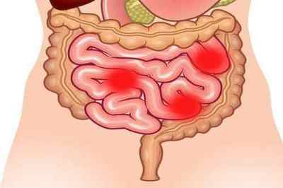 Захворювання тонкого кишечника: симптоми і лікування патологій