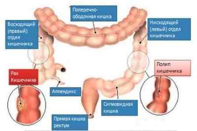 Захворювання товстого кишечника: симптоми, діагностика та лікування