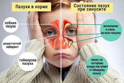 Закладений ніс у дитини - як і чим лікувати