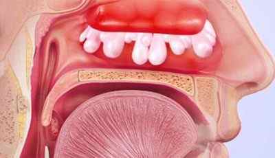 Закладеність носа при алергії: симптоми, лікування