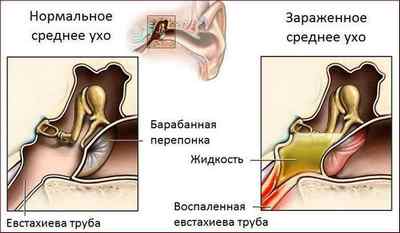 Закладеність і шум у вусі: причини і лікування
