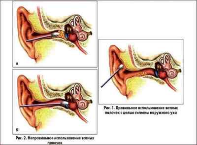 Закладеність і шум у вусі: причини і лікування