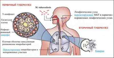 Закрита форма туберкульозу легенів: небезпека і особливості