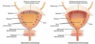 Залишкова сеча в сечовому міхурі у чоловіків і жінок
