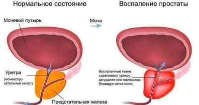 Залишкова сеча в сечовому міхурі у чоловіків і жінок