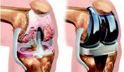 Заміна колінних суглобів (ендопротезування): реабілітація після операції та відгуки, як отримати квоту | Ревматолог