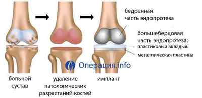 Заміна колінного суглоба: операція, реабілітація