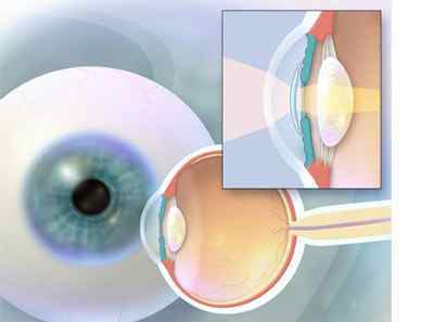 Заміна кришталика ока: операція, ціни, відгуки, при катаракті